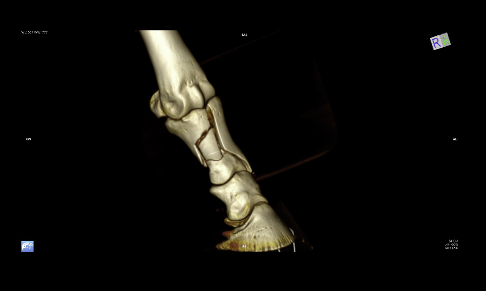 3D imaging helps the surgeon visualise the fracture and plan the operation effectively