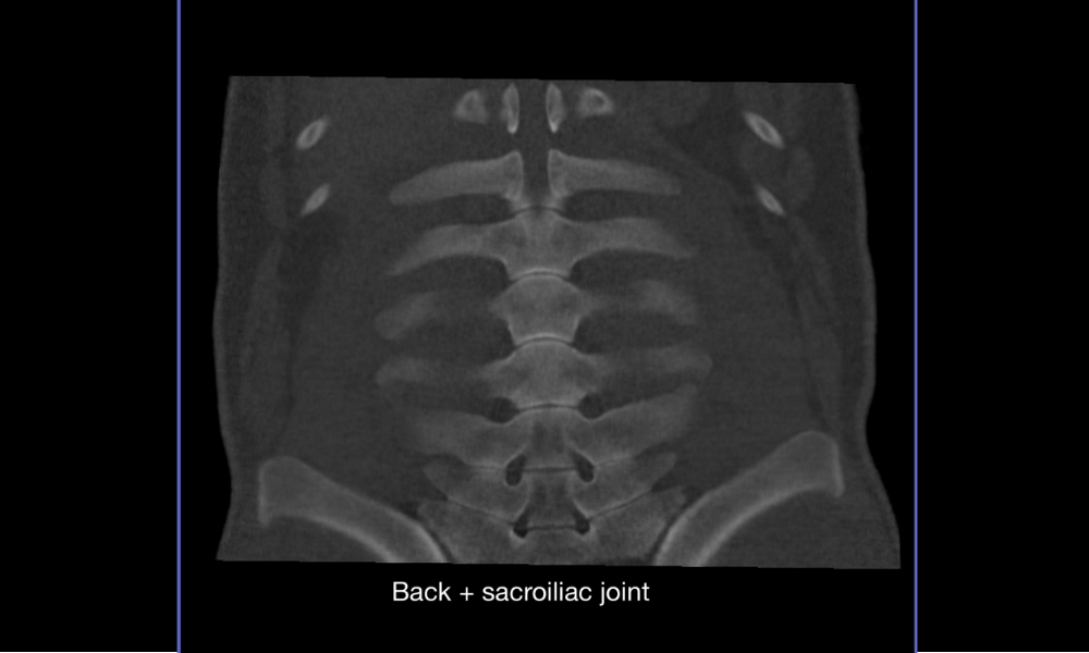 Lumbar spines and sacroiliac joint of an anaesthetized horse
