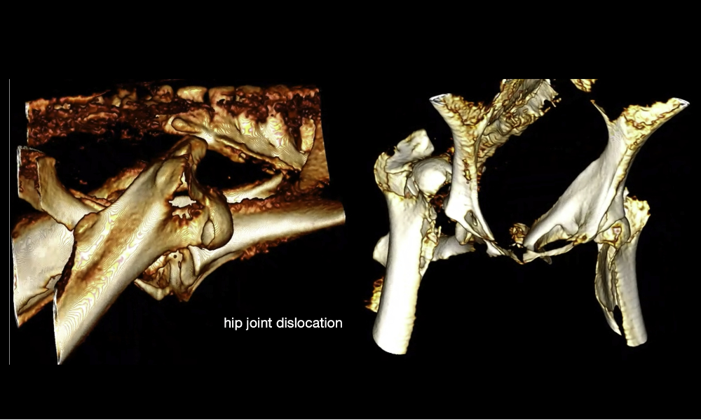 3D images of a dislocated hip joint