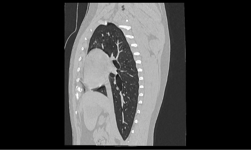 Thorax CT scan of a dog in the sagittal plane