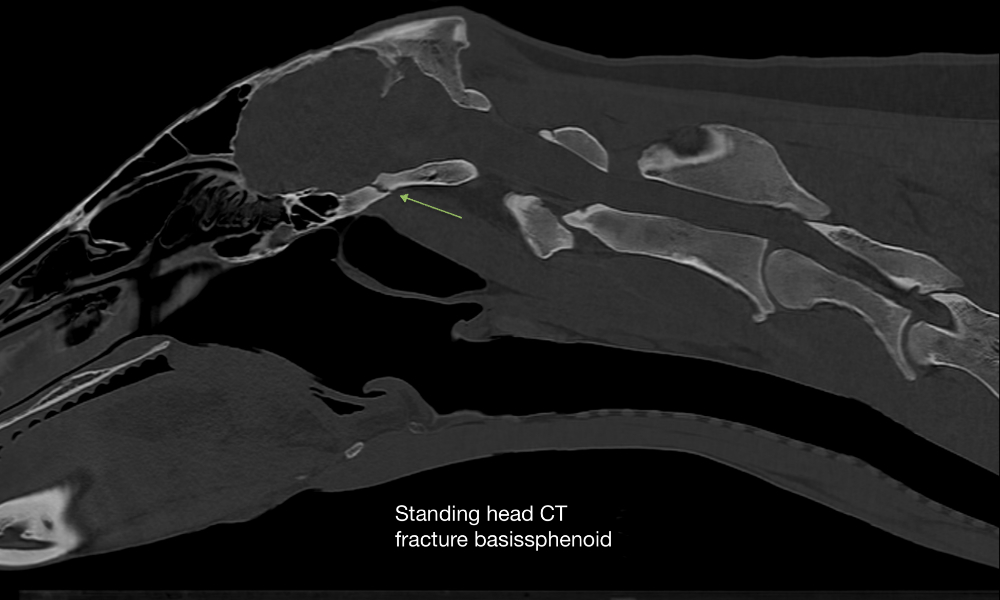 Fractured basissphenoid