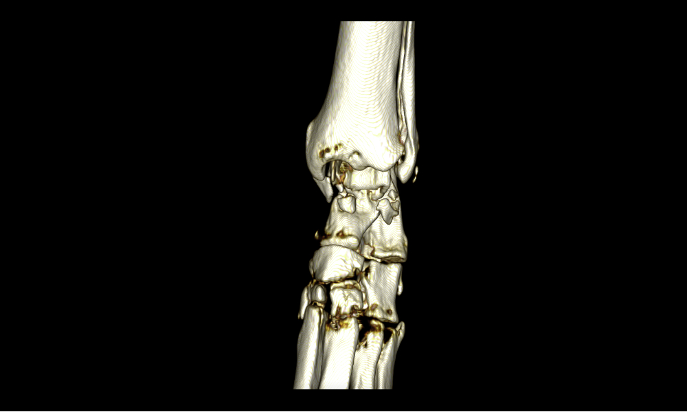 Severe arthrosis of a dog’s carpus