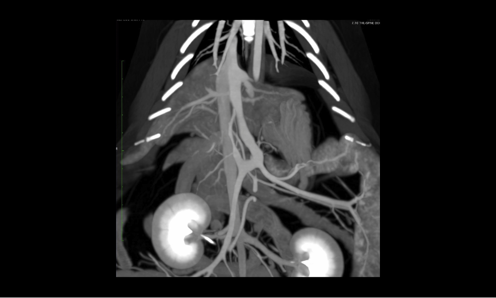 Angio-CT enables detailed visualisation of vessels and internal organs such as kidneys thanks to outstanding software functions
