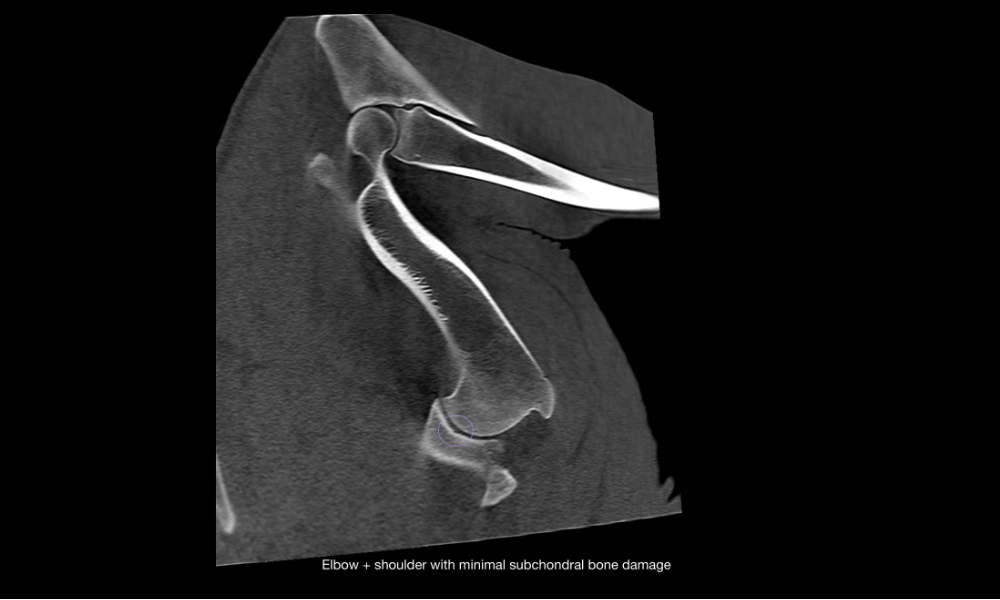 Elbow and shoulder scan showing minor subchondral bone changes in the shoulder joint