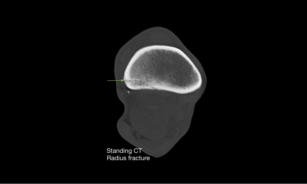 Fissure line in the distal radius in a standing CT scan