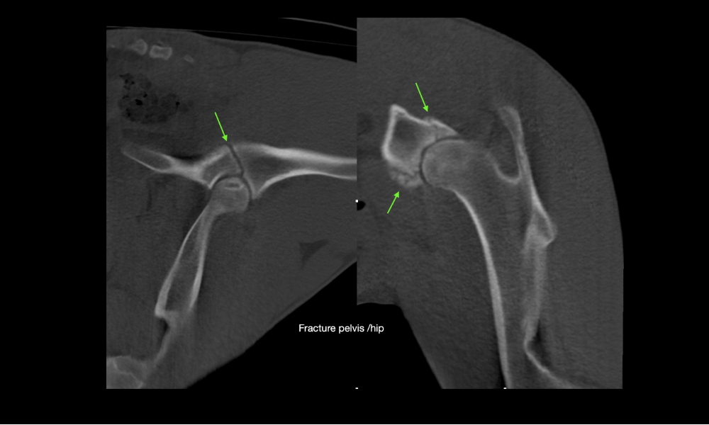 Multiple fractured hip joint