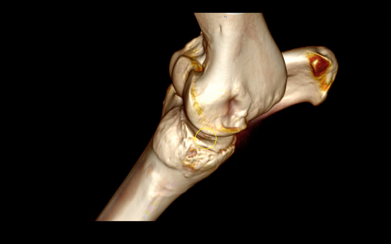 3D reconstruction of an elbow with severe joint cartilage damage