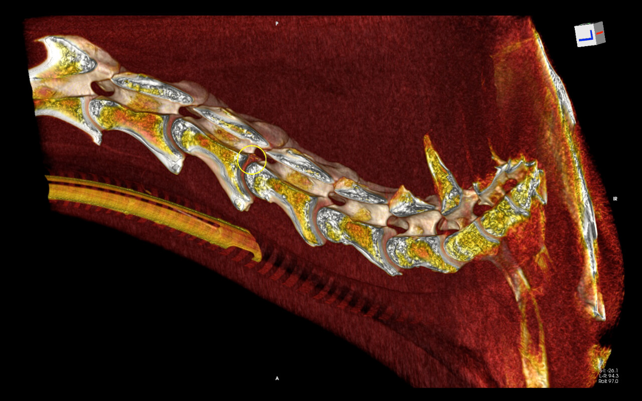 3D reconstruction of a caudal neck scan done under GA: Discopathy at C4/5