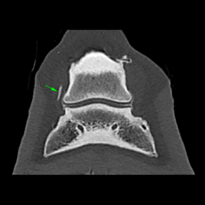 Accumulation of contrast agent in the CL lesion during a DIPJ arthrography