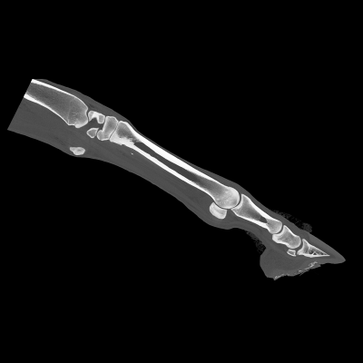 Standing CT scans up to the distal part of the radius