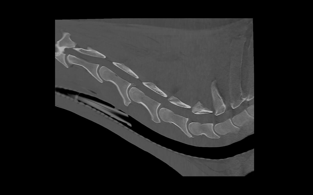 Mineralisation and protrusion of the intervertebral disc at C4/5 in the bone window