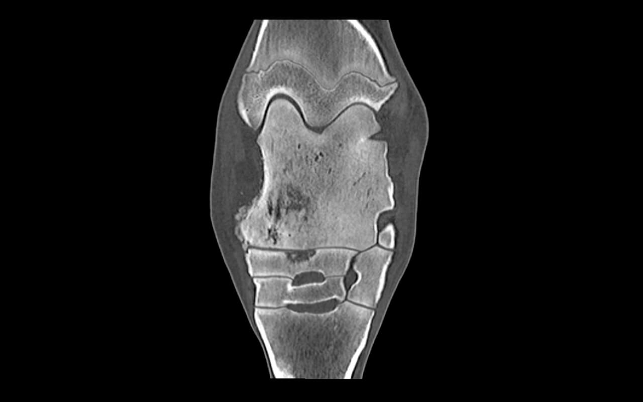 New bone formation and lytic lesions in talus and central tarsal bone