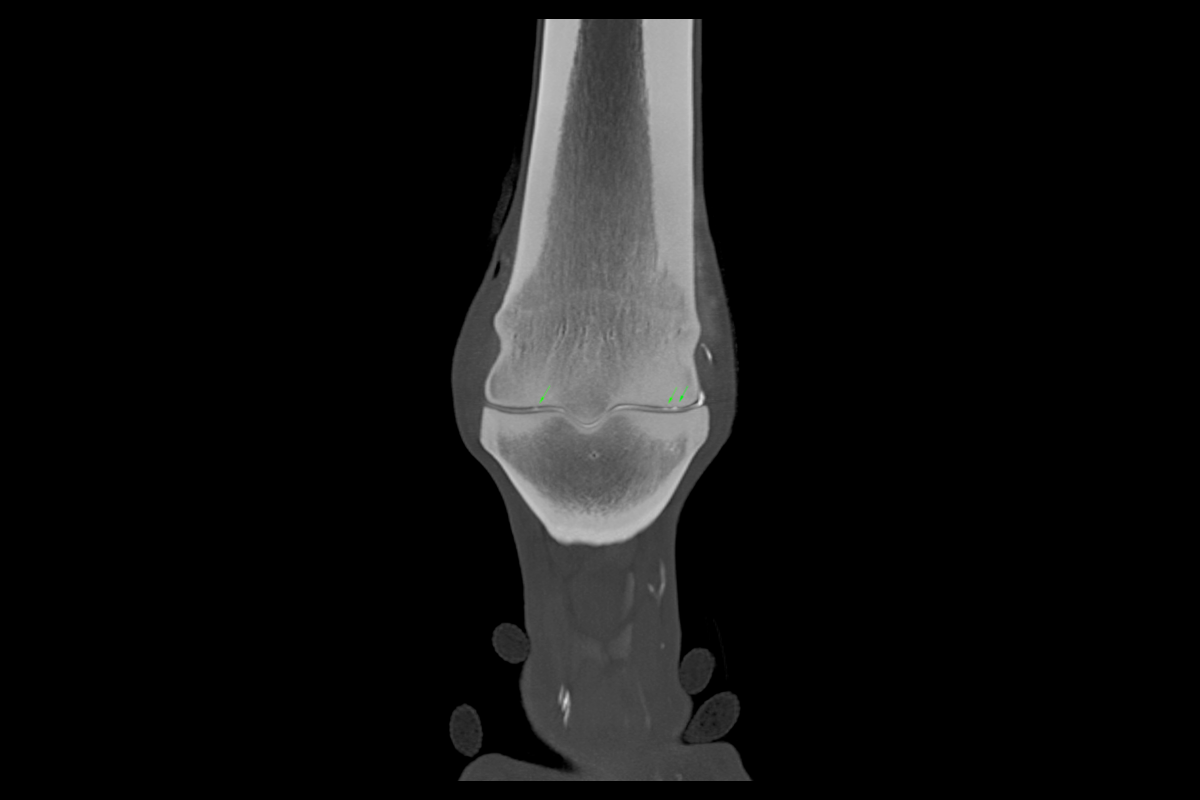 Osteoarthritis in the fetlock - CT arthrography of the standing, non weight bearing limb enables separation of both articular surfaces and shows multiple lesions in the joint cartilage of varying depth