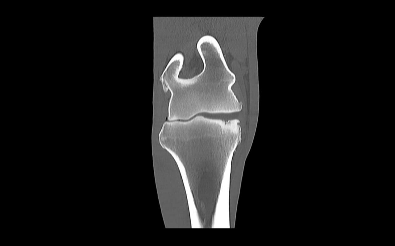 Sever subchondral lytic bone lesion proximo-medial in the radial bone surrounded by severe bone sclerosis