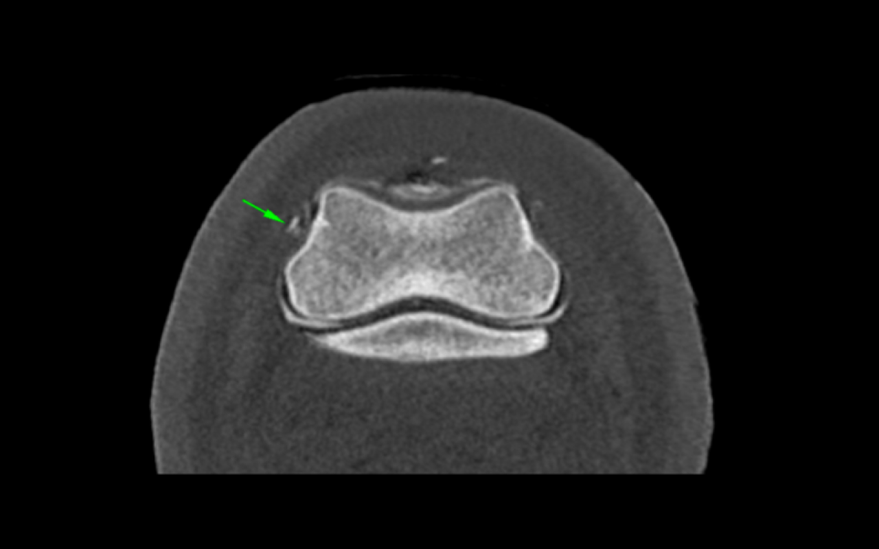 Contrast medium accumulation in the CL lesion of the DIP joint