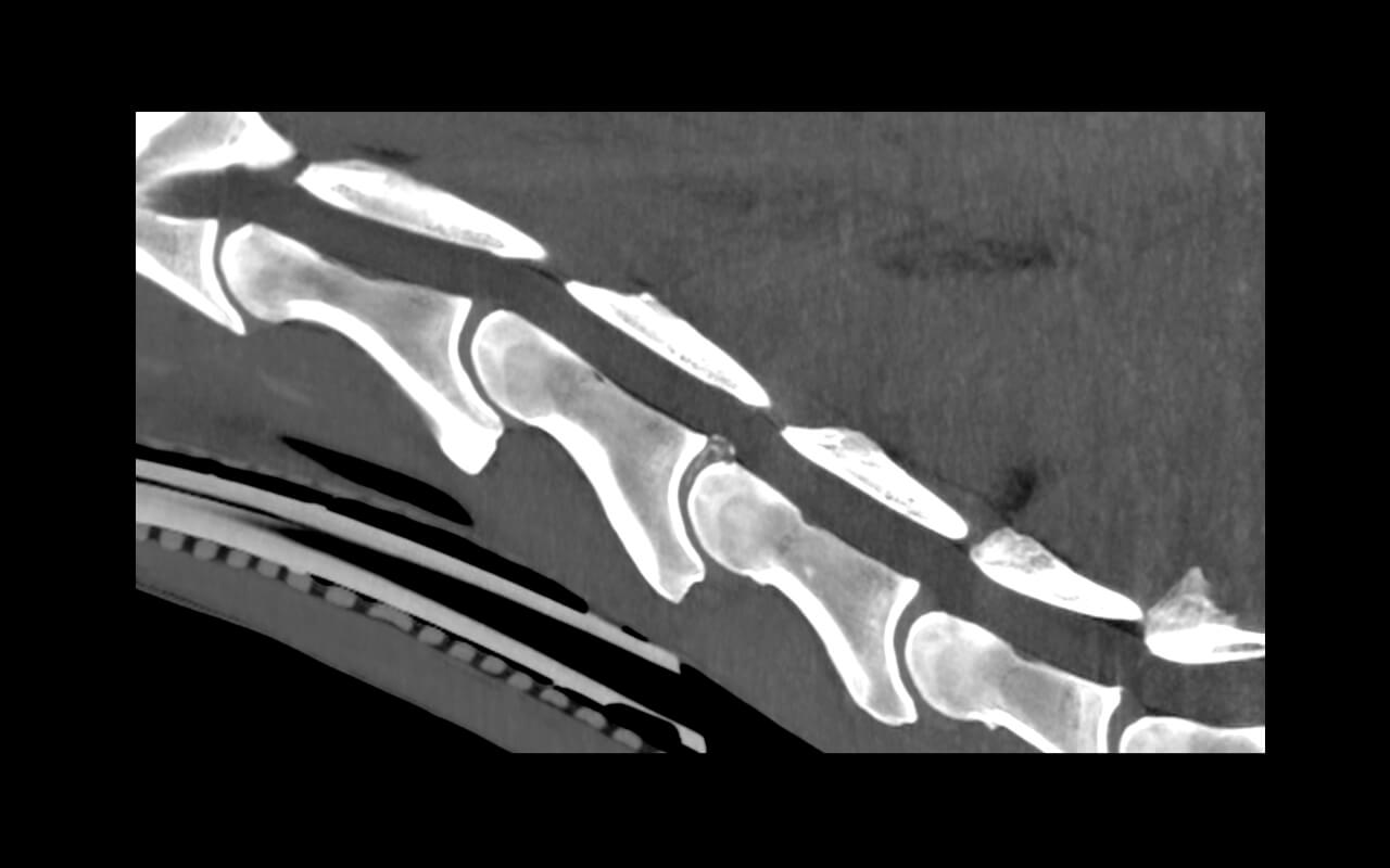 Mineralisation and protrusion of the intervertebral disc at C4/5 in the soft tissue window