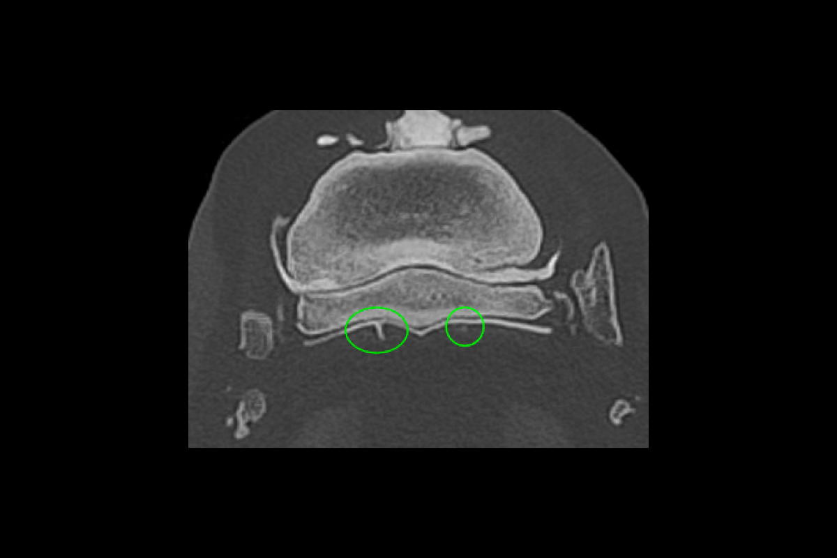 Bone scan (contrast study) at the level of the navicular bone highlights DDFT lesion with contrast accumulation