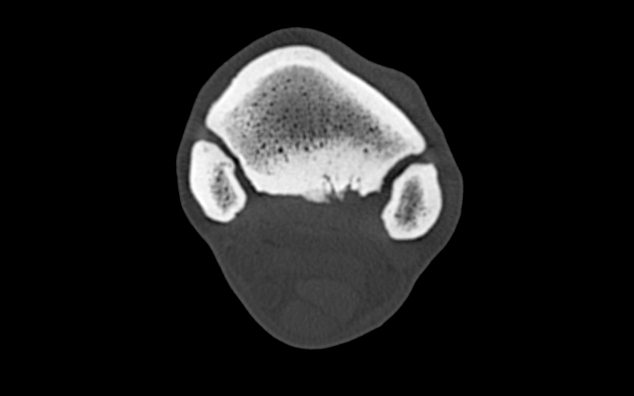 Lytic lesions and sclerosis in proximo-palmar MC3 at the attachment of HSL