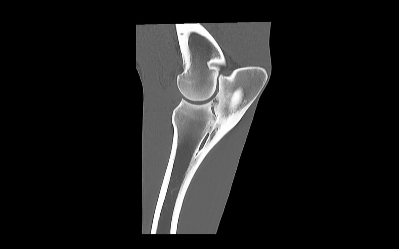 Isolated small bone fragment in the palmar elbow joint and cyst-like bone lesions on the proximal radioulnar articulation