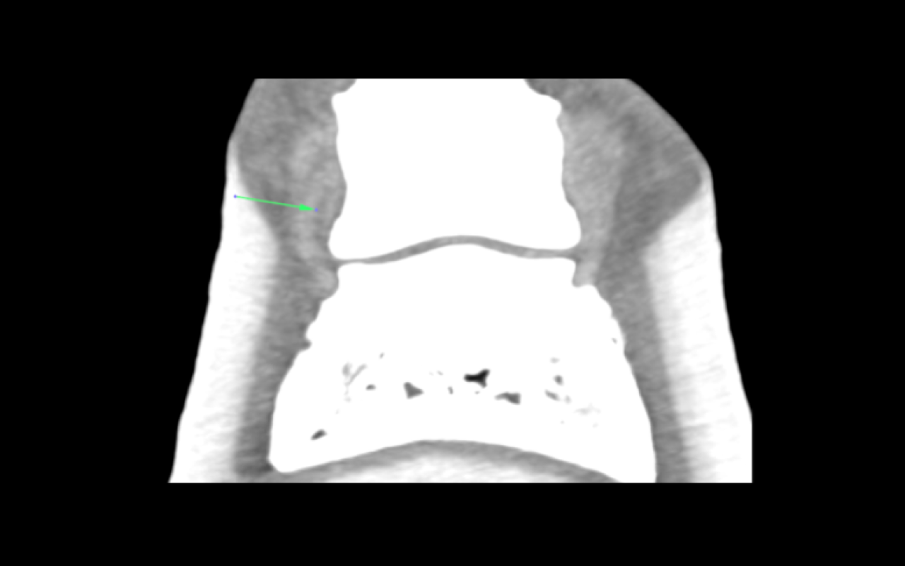 Longitudinal split the medial CL of the DIP joint