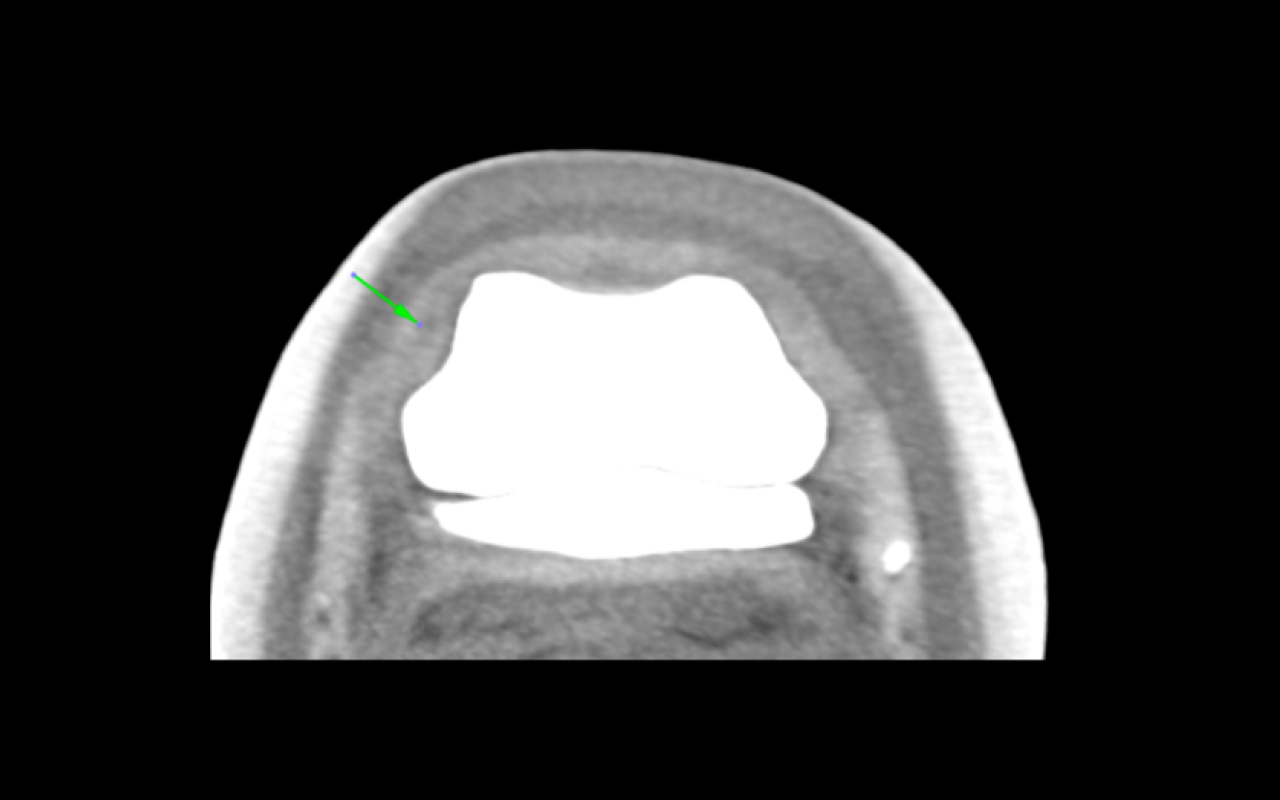 Defect in the medial CL of the DIP joint