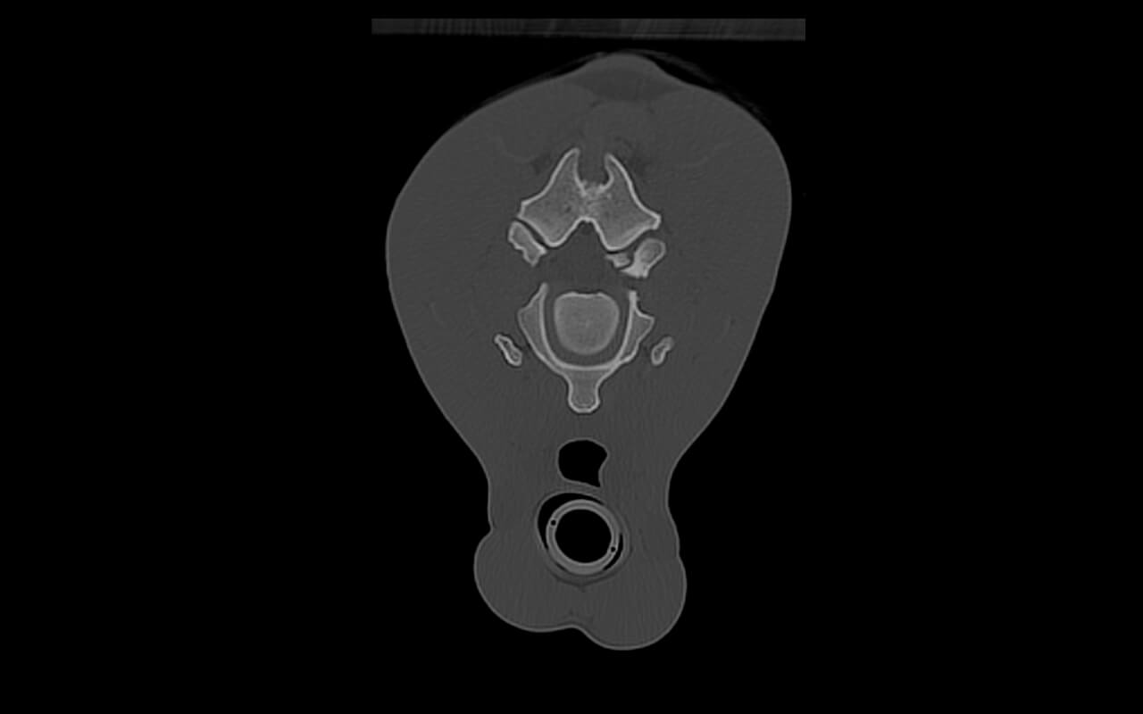 Bony fragment at the level of C2/3 affects the spinal cord