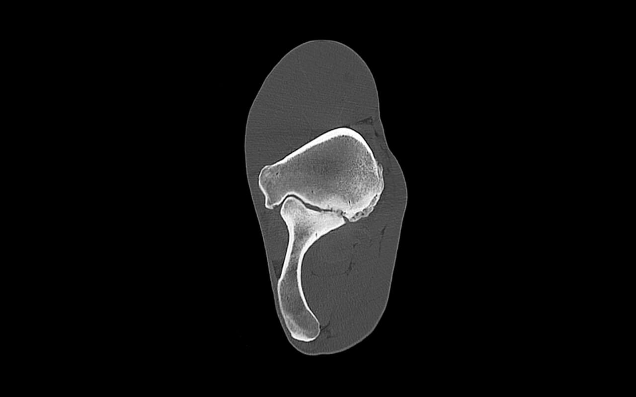 Periosteal bone formation on an elbow
