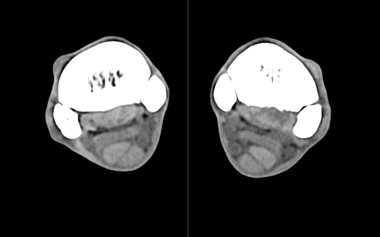 Comparative soft tissue section of both front limbs: Severe core lesion and hypertrophy of left HSL with bone remodelling of MC3