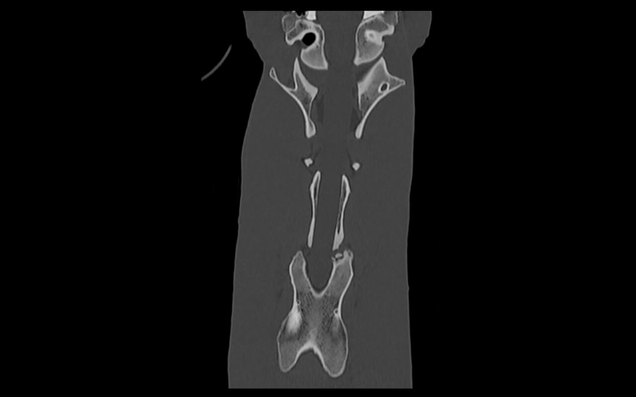Bony fragment at C2/3 in the coronal plane