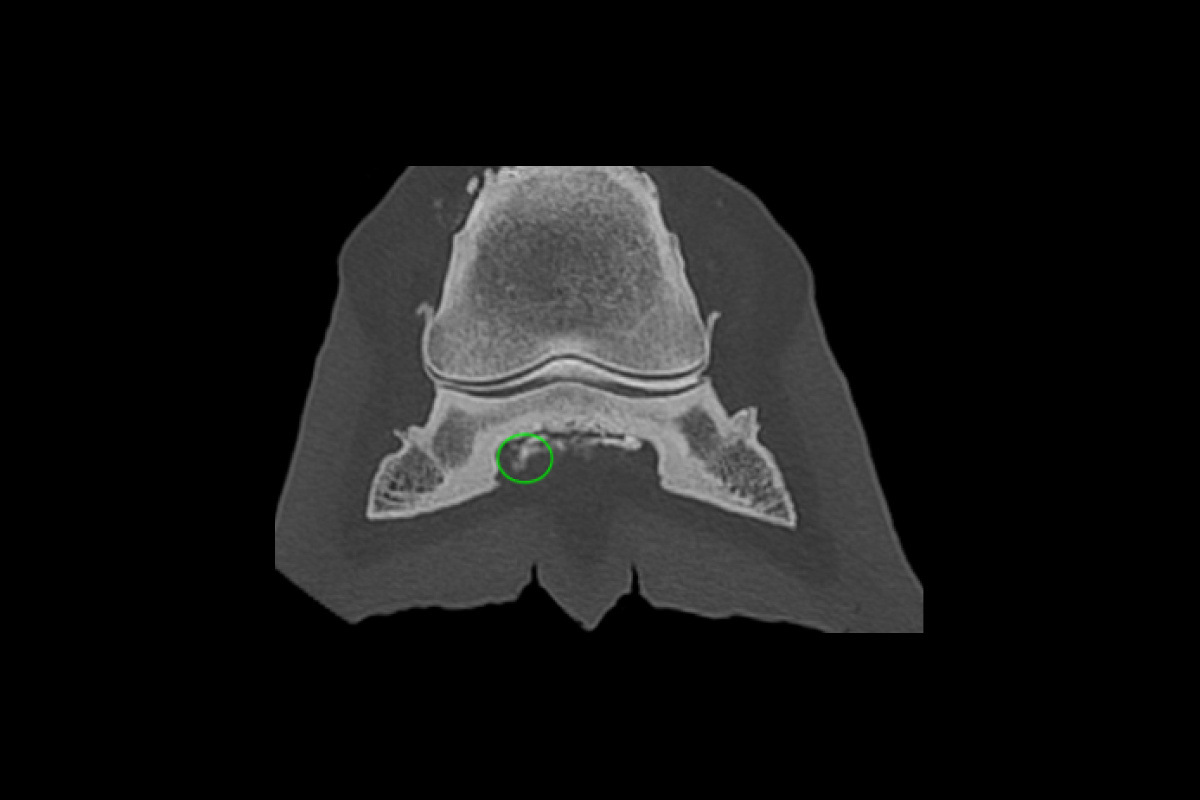 Contrast study of an insertional tendinopathy in the medial branch of the DDFT