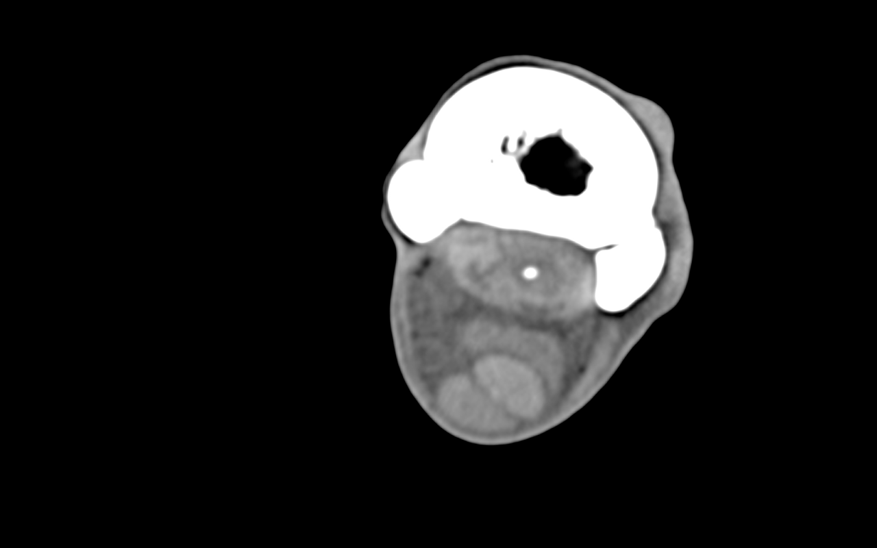 Transverse soft tissue window shows hypertrophy and mineralization of the HSL