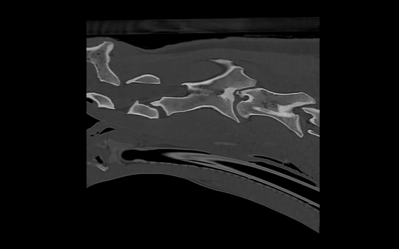 Bony fragment at C2/3 in the sagittal plane