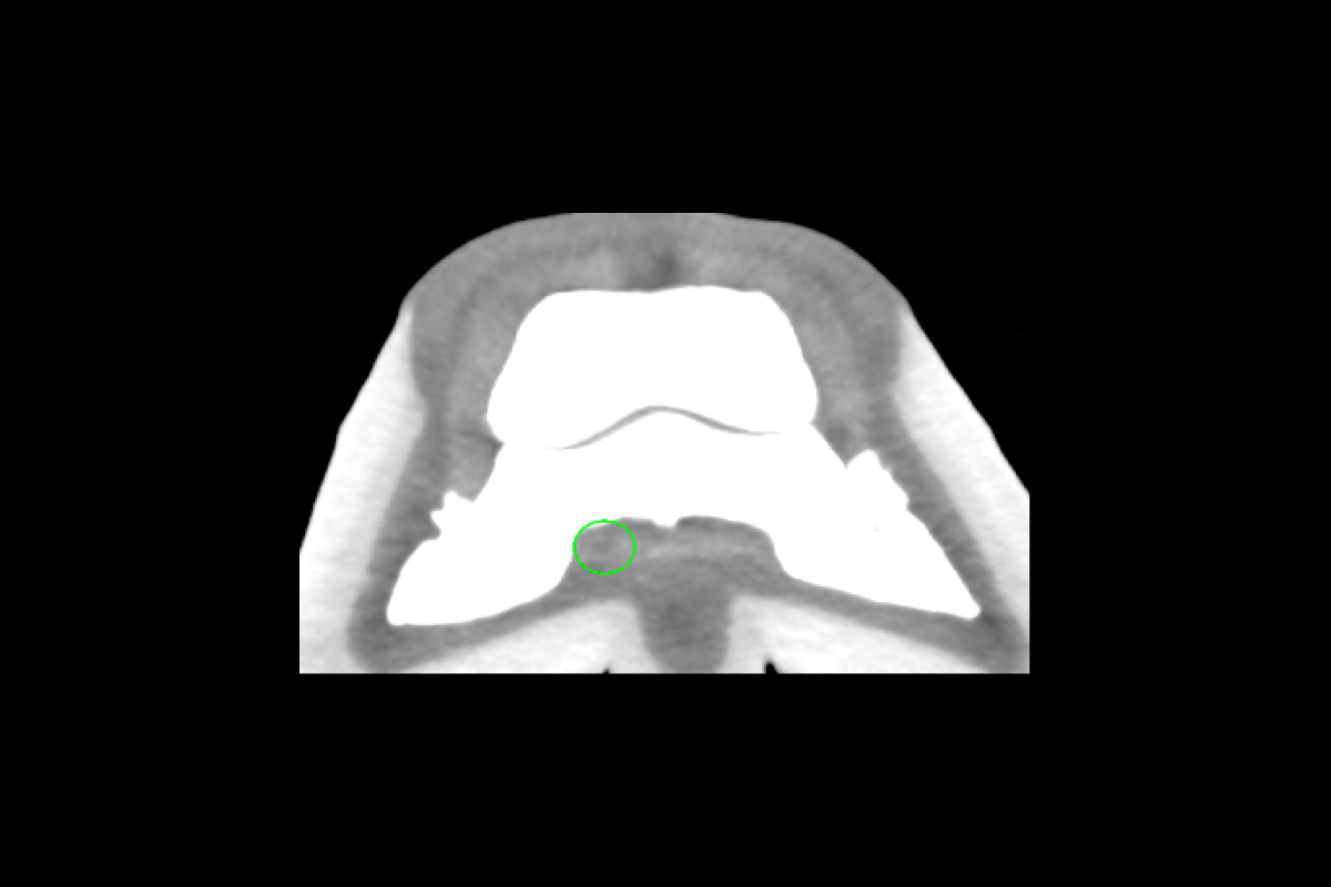 Insertional tendinopathy in the medial branch of the DDFT