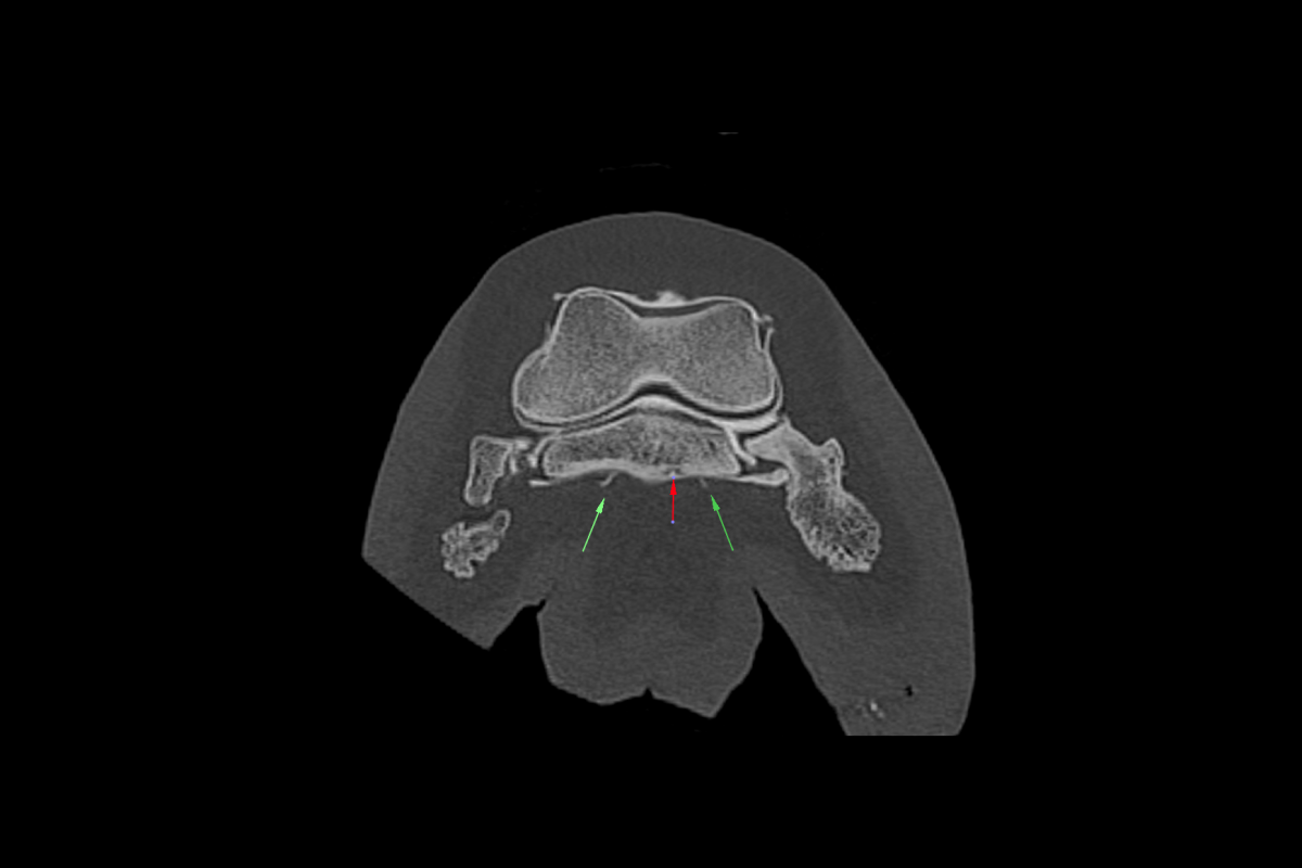Contrast medium accumulation in the area of the longitudinal DDFT lesions at the level of the navicular bone (green arrows) and focal