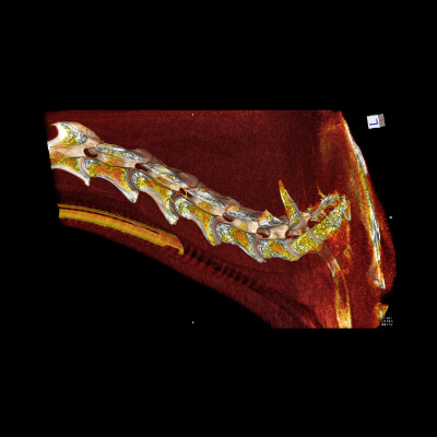 3D reconstruction of a caudal neck scan done under GA: Discopathy at C4/5